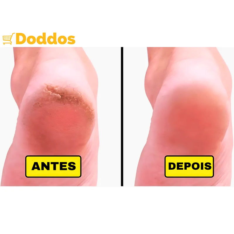 Protetor para Calcanhar de Silicone: A solução para o seu conforto e bem-estar!